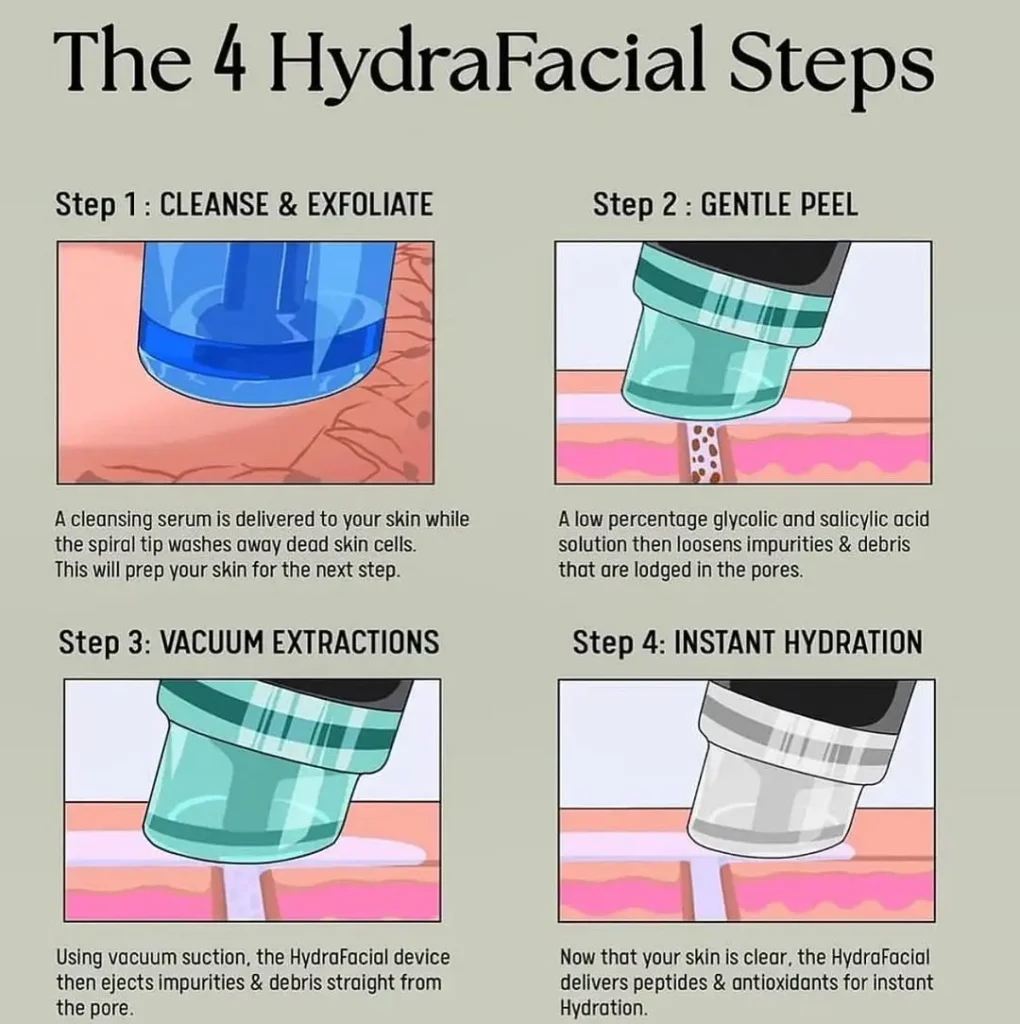 what is a hydrafacial – hydrafacial steps infographic