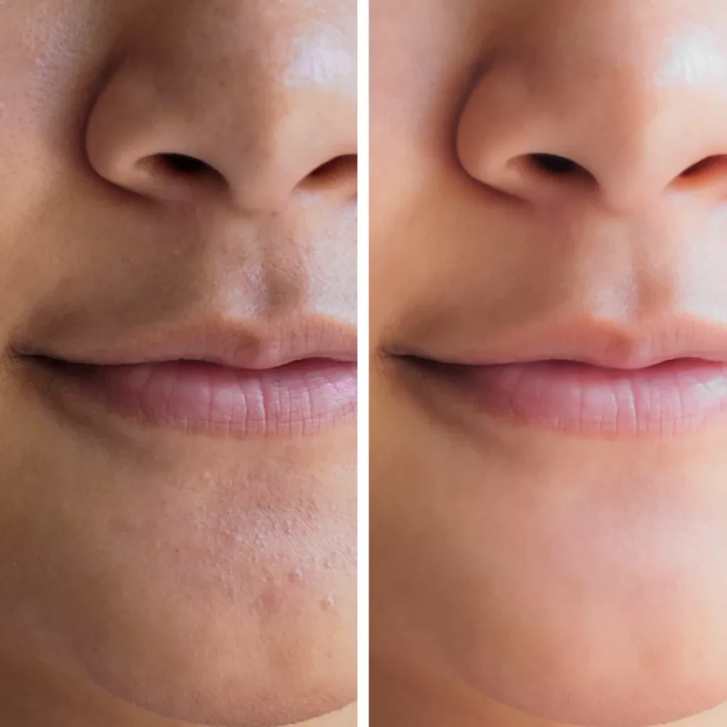 hydrafacial treatment in NYC – Skincare Sommelier Forest Hills