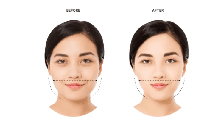 Masseter Botox before and after timeline (graphics)