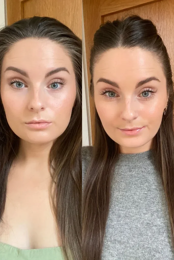 Jaw slimming results after masseter Botox in Queens