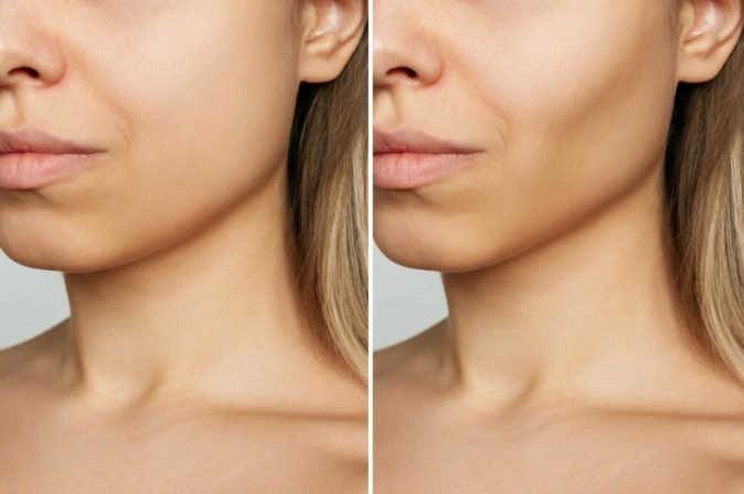 Non-surgical jawline contouring with masseter Botox in NYC