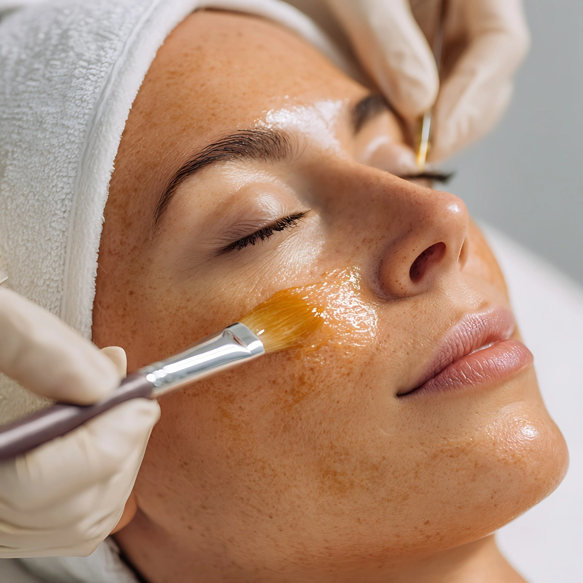 Chemical peels for hyperpigmentation treatment at Skincare Sommelier showing improved skin tone and reduced dark spots