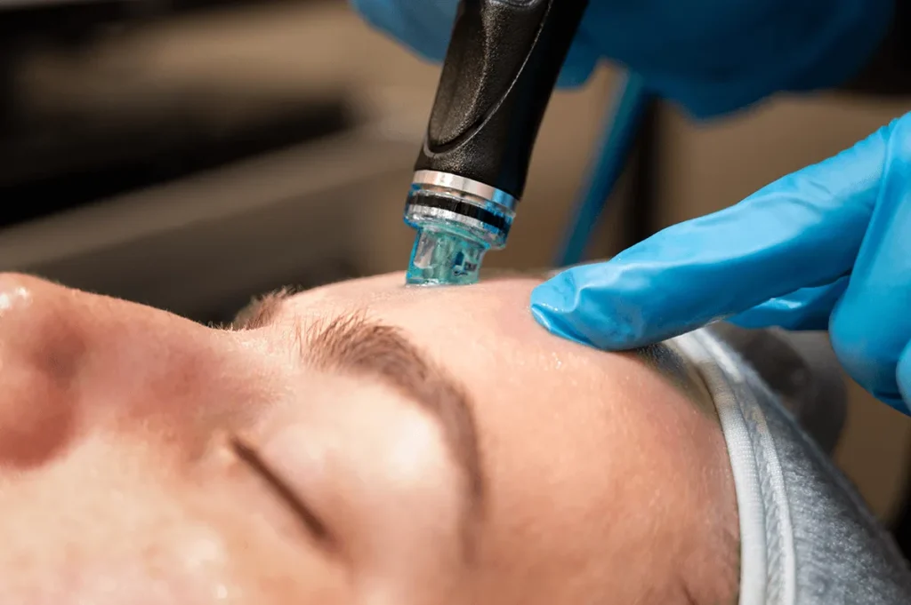 HydraFacial procedure closeup showing vortex tip application during facial treatment at Skincare Sommelier