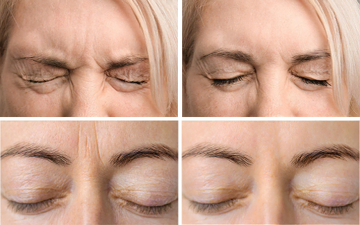 Botox treatment for forehead wrinkles – before and after results in Forest Hills, Queens