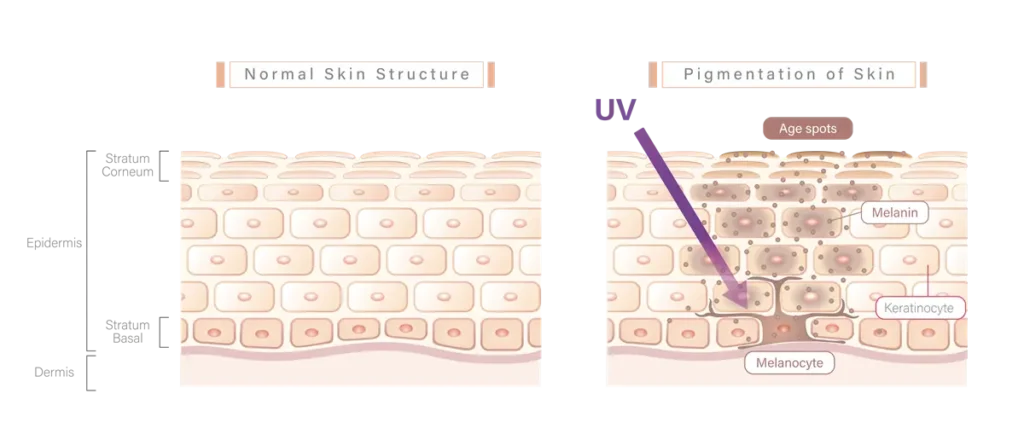 Vector diagram comparing the structure of healthy skin to skin with epidermal hyperpigmentation and age spots for educational purposes.