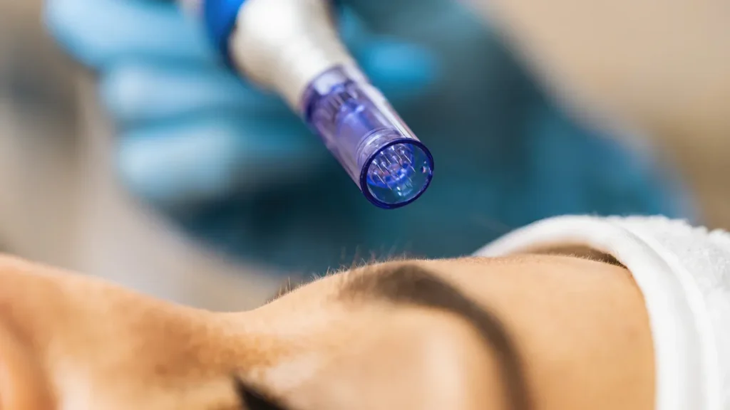 Close-up of a professional microneedling treatment being performed on a client's face at Skincare Sommelier Beauty Lab & Med Spa in NYC.