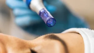 Close-up of a professional microneedling treatment being performed on a client's face at Skincare Sommelier Beauty Lab & Med Spa in NYC.