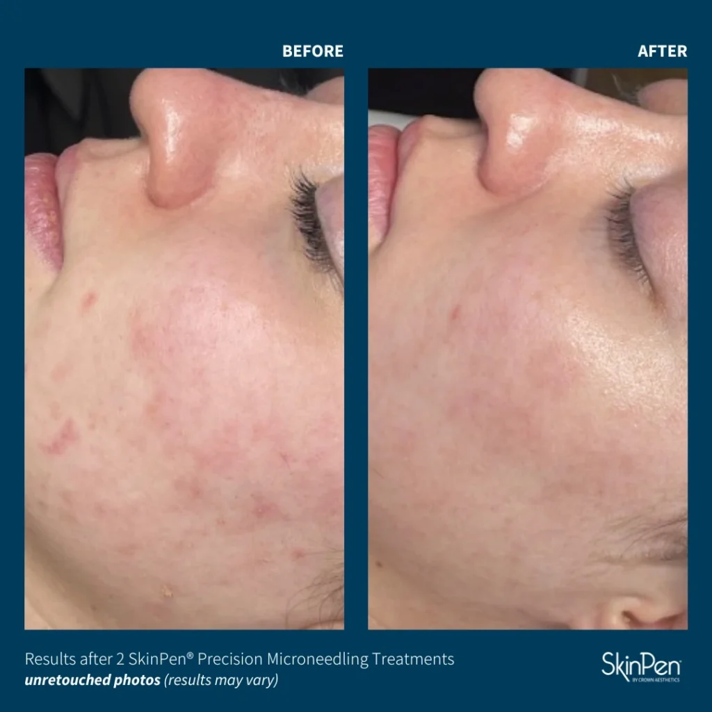 Before and after results of 2 SkinPen microneedling benefits for acne scars and skin texture at Skincare Sommelier NYC