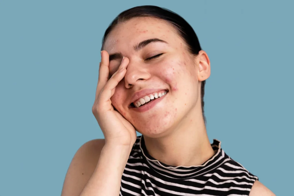 Young woman with skin inflammation and acne scars seeking PDRN treatment in Forest Hills, NY.