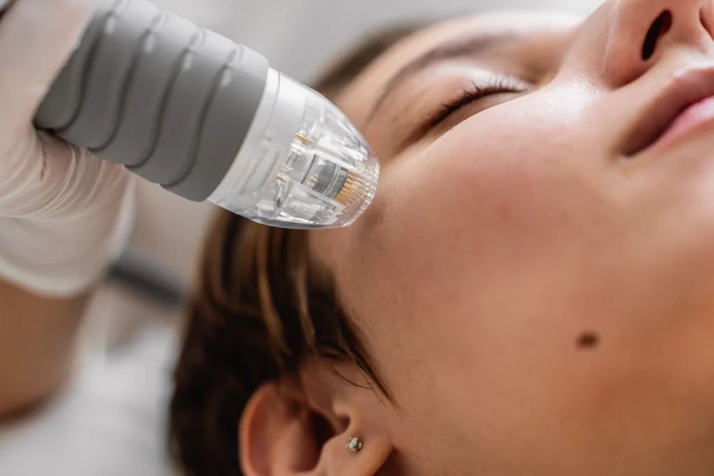 A close-up view of an advanced microneedling device treating the skin, comparing SkinPen and Sylfirm X technologies for microneedling in the summer.