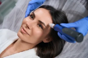 Woman receiving microneedling treatment on forehead at a Forest Hills skincare clinic